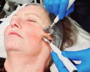 micro current electrical facial caci