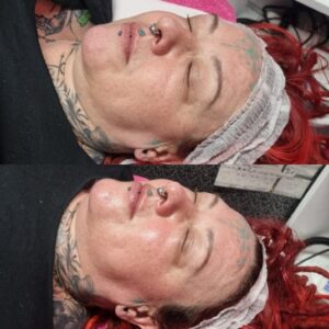 Chemical Peel Facial Learn & Apply at Home