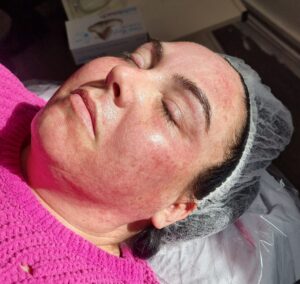 Editable Microneedling Course Manual