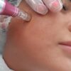 Microneedling Accredited Course