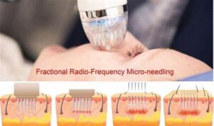 fractional radio frequency facial microneedling radio frequency