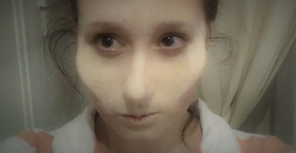 2 cheek prosthetic