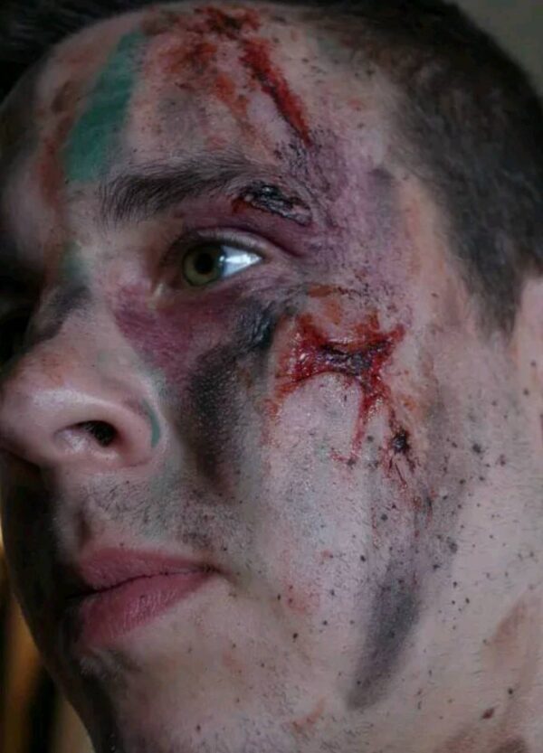 2 small wounds/injury