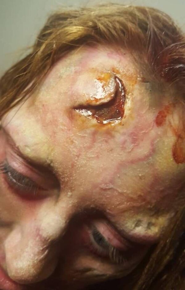 forehead injury wound prosthetic