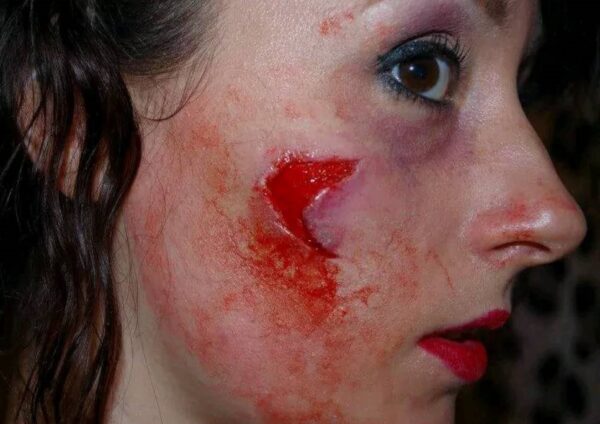 2 small sharp cheek wound injury