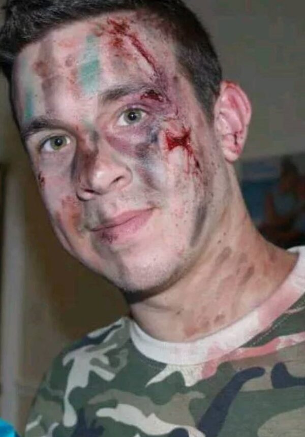 2 small sharp cheek wound injury